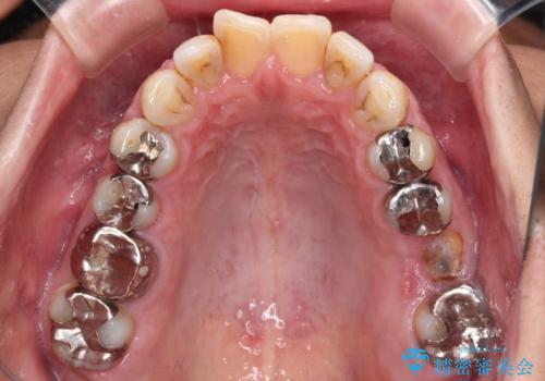 欠損と痛み 奥歯のむし歯治療の治療前