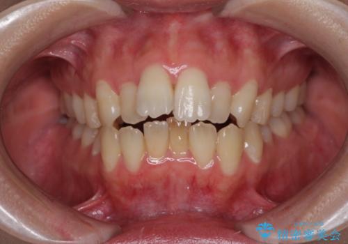 Eラインを改善したい ハーフリンガルによる抜歯矯正の症例 治療前