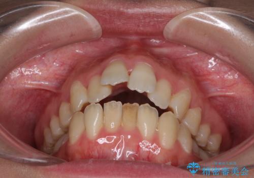 Eラインを改善したい ハーフリンガルによる抜歯矯正の治療前