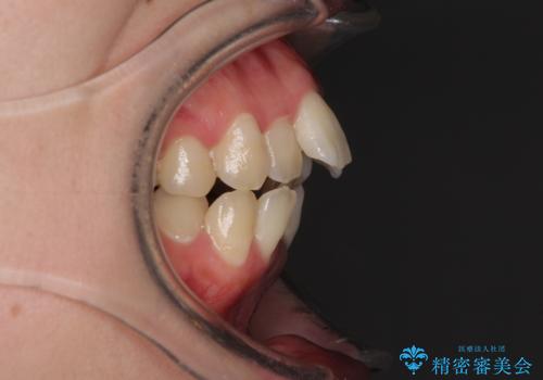 Eラインを改善したい ハーフリンガルによる抜歯矯正の治療前