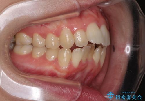 Eラインを改善したい ハーフリンガルによる抜歯矯正の治療前