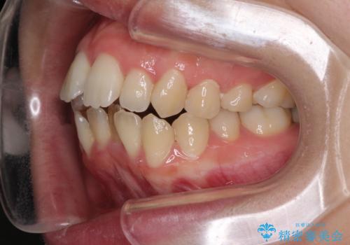 Eラインを改善したい ハーフリンガルによる抜歯矯正の治療前