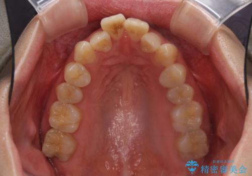 Eラインを改善したい ハーフリンガルによる抜歯矯正の治療前