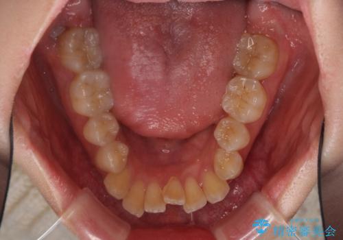 Eラインを改善したい ハーフリンガルによる抜歯矯正の治療前