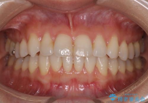 八重歯と前歯のガタガタをインビザラインでの症例 治療後
