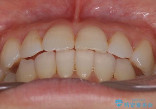 八重歯と前歯のガタガタをインビザラインでの治療後