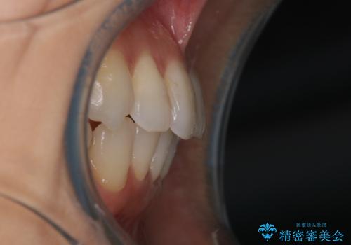 八重歯と前歯のガタガタをインビザラインでの治療後