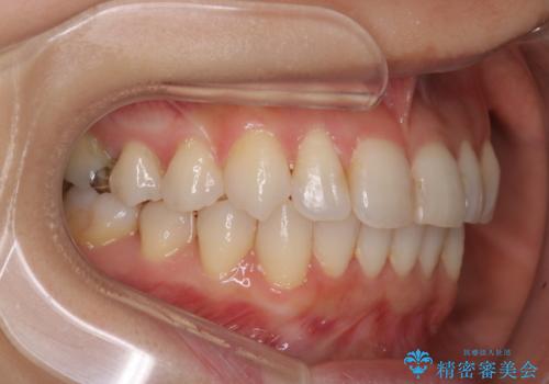 八重歯と前歯のガタガタをインビザラインでの治療後