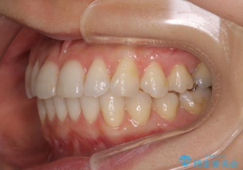 八重歯と前歯のガタガタをインビザラインでの治療後