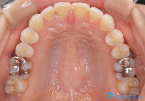 八重歯と前歯のガタガタをインビザラインでの治療後