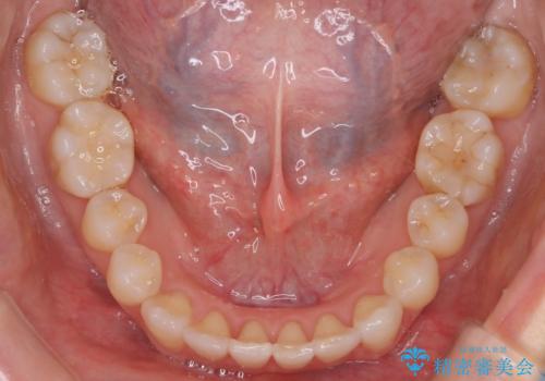八重歯と前歯のガタガタをインビザラインでの治療後