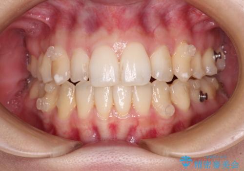 補助装置を併用したインビザラインでの八重歯の抜歯矯正の治療中