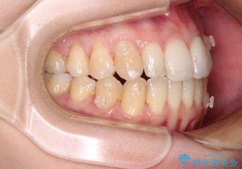 補助装置を併用したインビザラインでの八重歯の抜歯矯正の治療中