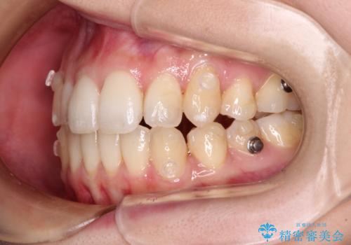 補助装置を併用したインビザラインでの八重歯の抜歯矯正の治療中