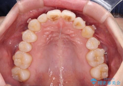 補助装置を併用したインビザラインでの八重歯の抜歯矯正の治療中