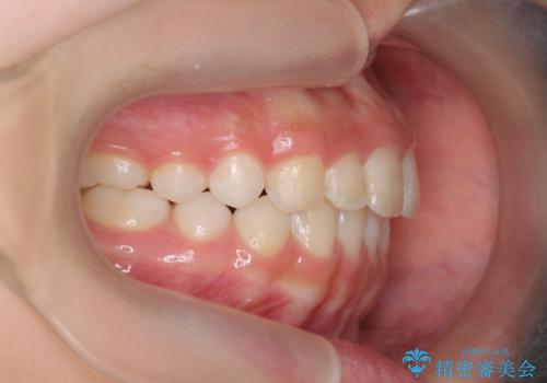 [ 出っ歯を治したい ]   マウスピース矯正での上顎前突治療の治療後