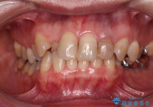 変色した前歯をオールセラミッククラウンで自然な口元にの治療前