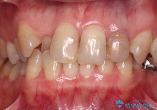 変色した前歯をオールセラミッククラウンで自然な口元にの治療前