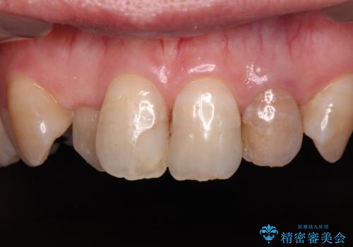 変色した前歯をオールセラミッククラウンで自然な口元にの症例 治療前