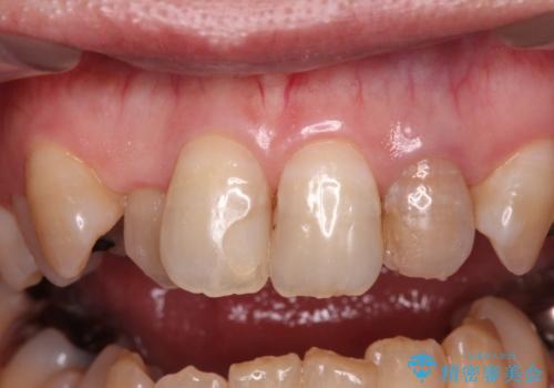 変色した前歯をオールセラミッククラウンで自然な口元にの治療前