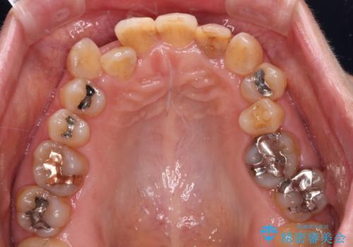 変色した前歯をオールセラミッククラウンで自然な口元にの治療前