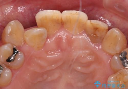 変色した前歯をオールセラミッククラウンで自然な口元にの治療前