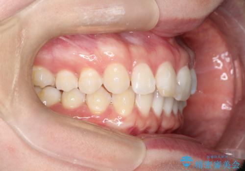 すきっ歯をインビザラインで目立たたずストレスなく矯正の治療中