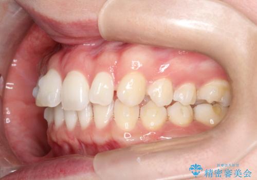 すきっ歯をインビザラインで目立たたずストレスなく矯正の治療中