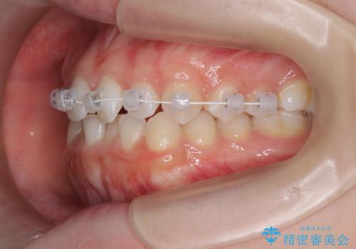 前歯のガタつきを改善　マウスピース矯正とワイヤー部分矯正の治療中