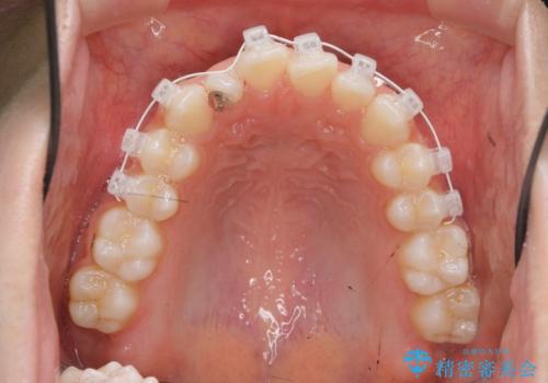 前歯のガタつきを改善　マウスピース矯正とワイヤー部分矯正の治療中