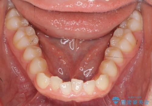 前歯のガタつきを改善　マウスピース矯正とワイヤー部分矯正の治療中