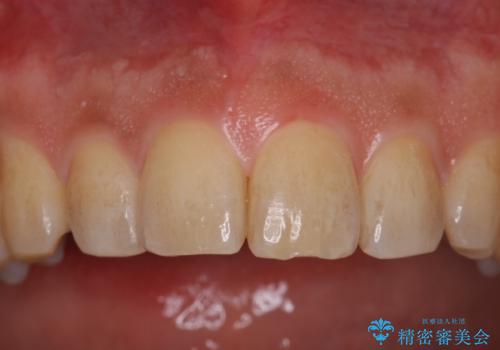 PMTCによる着色除去の症例 治療前