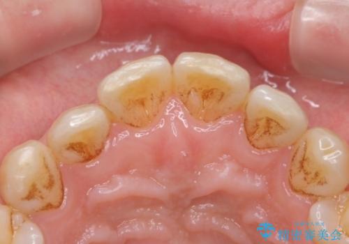 PMTCによる着色除去の治療前