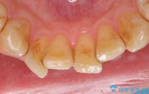 PMTCによる着色除去の治療前