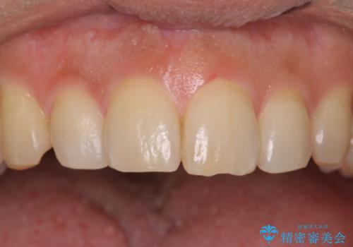 PMTCによる着色除去の症例 治療後