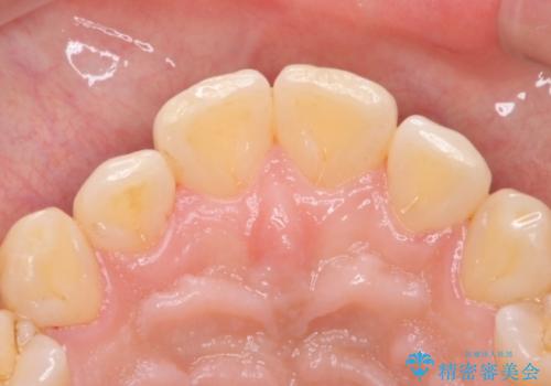 PMTCによる着色除去の治療後