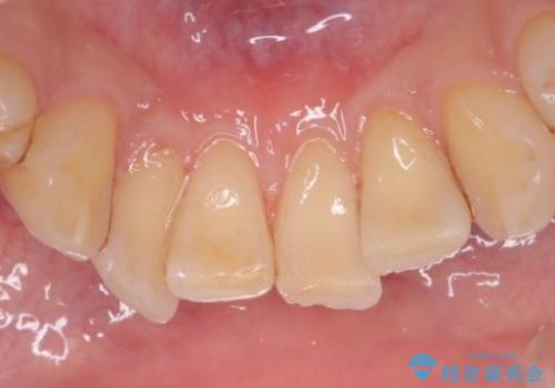 PMTCによる着色除去の治療後