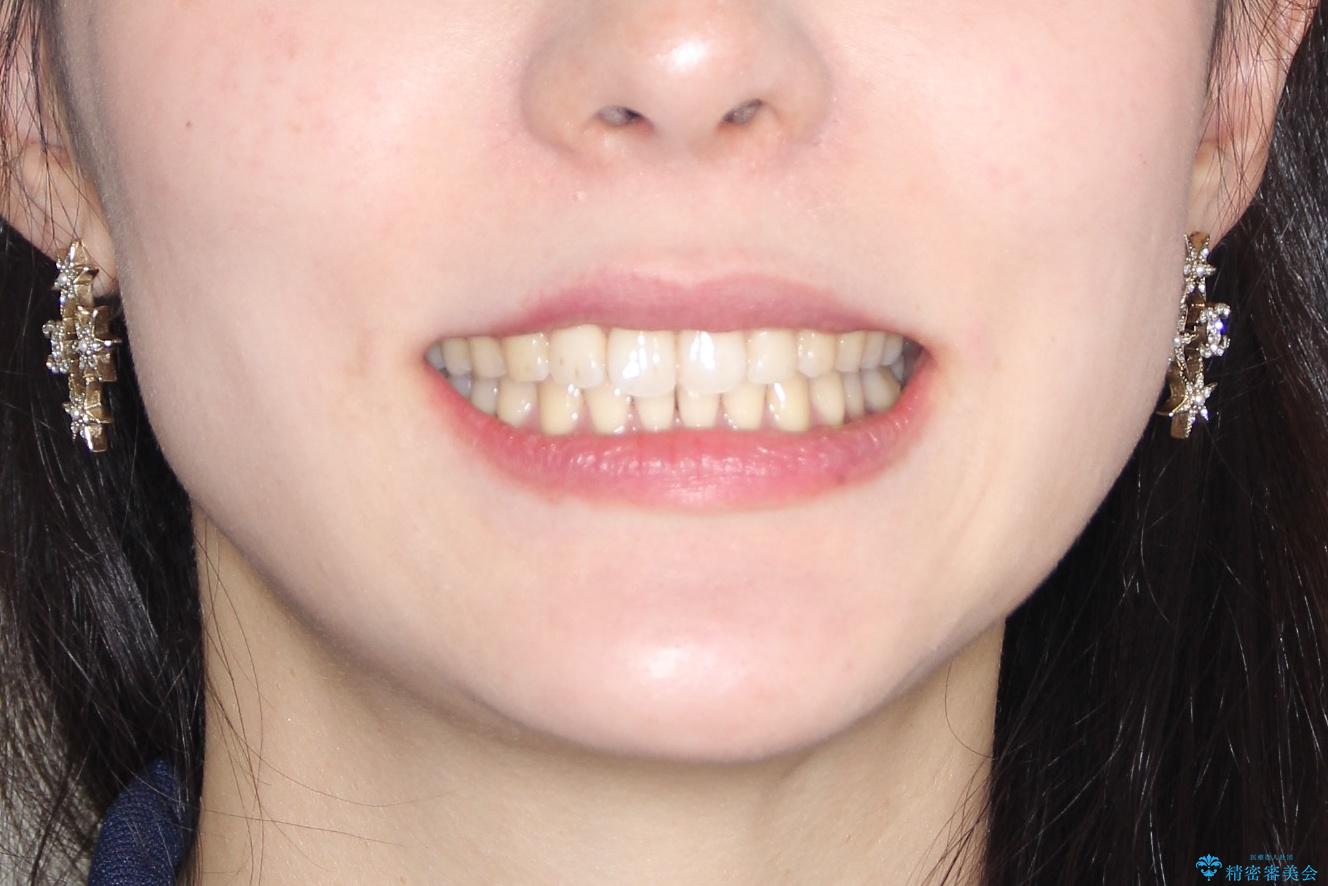 その前歯の捻じれ、原因は奥歯の噛み合わせのズレにあります。の治療後（顔貌）