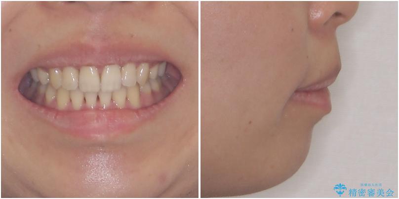 Eラインを改善したい　ハーフリンガルによる抜歯矯正の治療後（顔貌）