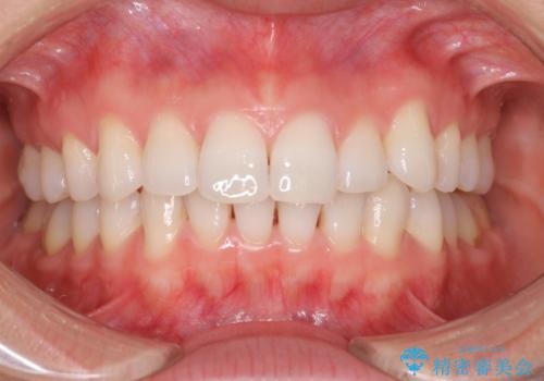 ホワイトニングで自然な白い歯への症例 治療前