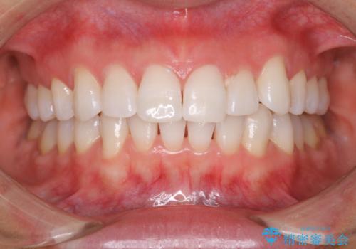 ホワイトニングで自然な白い歯への症例 治療後