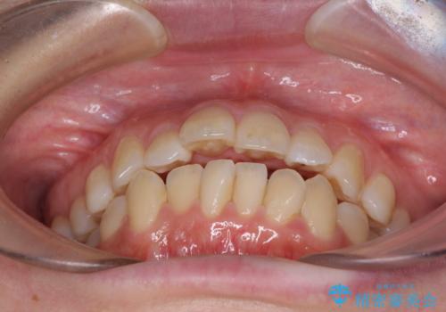 出っ歯を改善　目立たないワイヤー装置での抜歯矯正の治療前