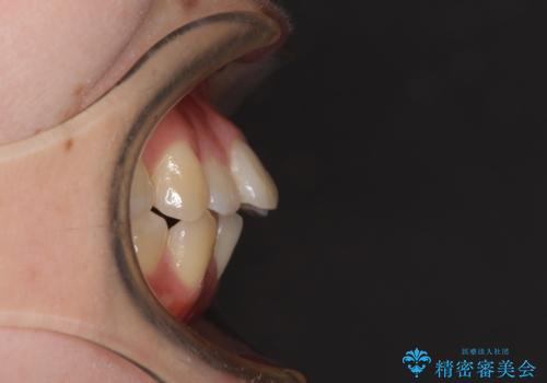 出っ歯を改善　目立たないワイヤー装置での抜歯矯正の治療前