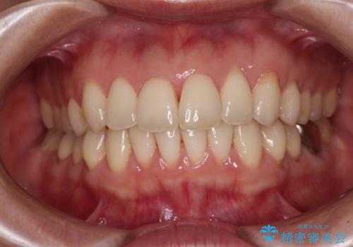 出産をしながら歯列を整える インビザラインによる矯正治療の治療中