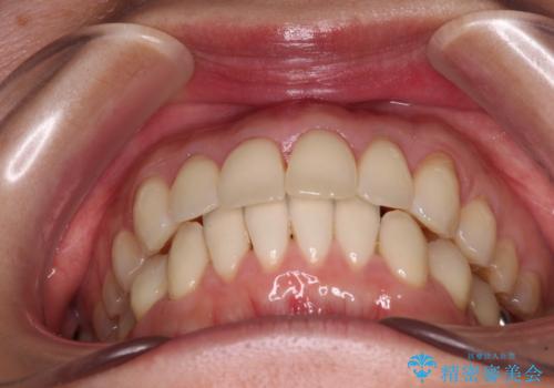 出産をしながら歯列を整える インビザラインによる矯正治療の治療中