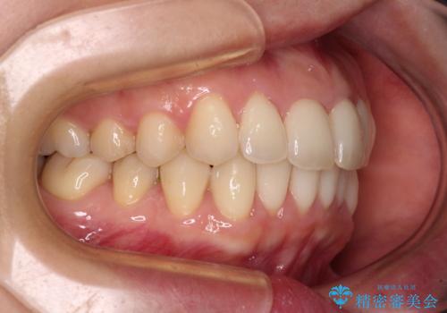 出産をしながら歯列を整える インビザラインによる矯正治療の治療中