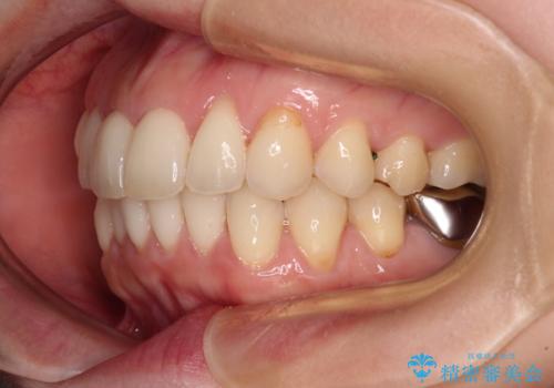 出産をしながら歯列を整える インビザラインによる矯正治療の治療中