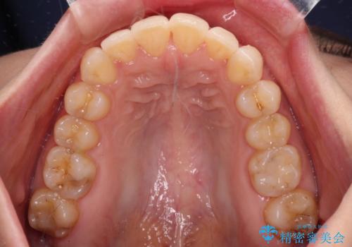 出産をしながら歯列を整える インビザラインによる矯正治療の治療中