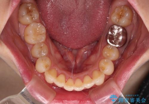 出産をしながら歯列を整える インビザラインによる矯正治療の治療中