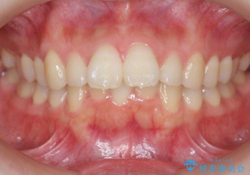 マウスピースで出っ歯感の改善の症例 治療前